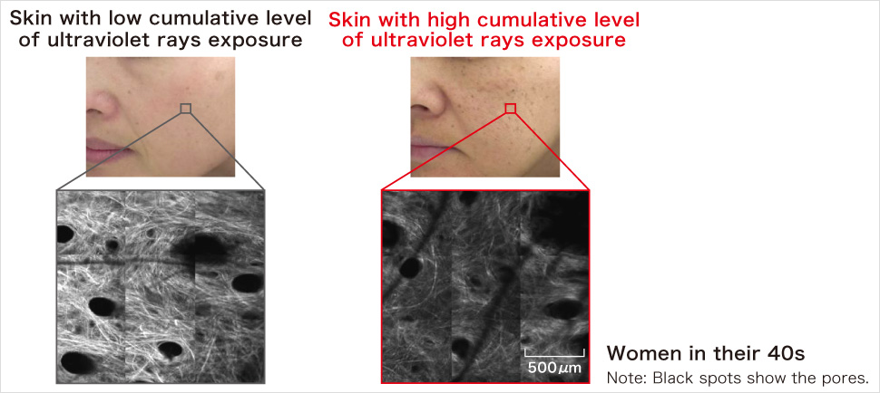 Skin with low cumulative level of ultraviolet rays exposure Skin with high cumulative level of ultraviolet rays exposure