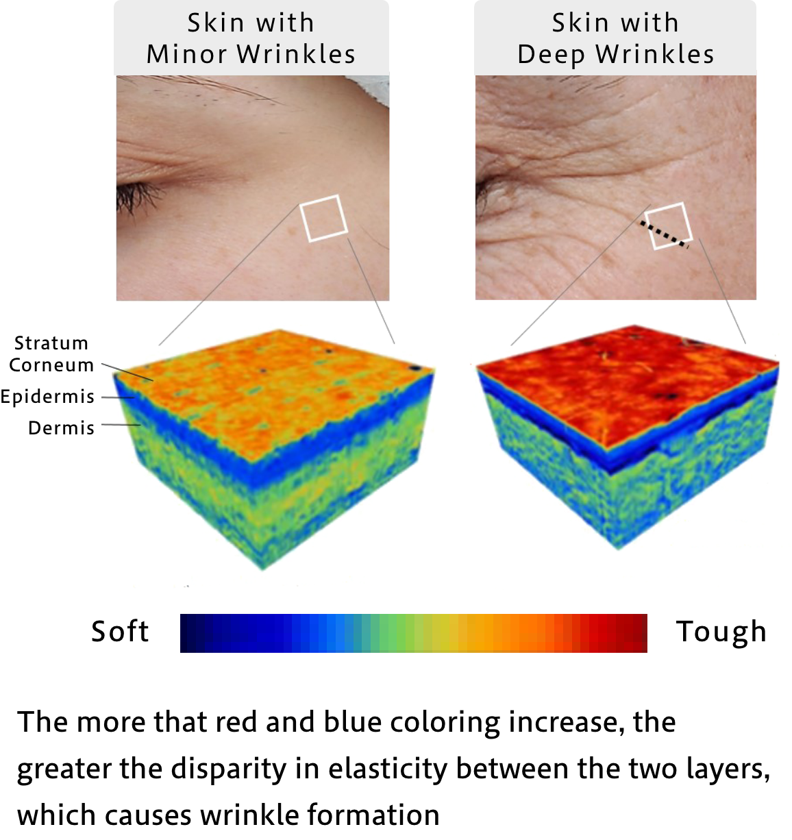 Shiseido’s world-first technology has enabled discovery of the “root causes behind wrinkles.” When the skin’s stratum corneum layer becomes too hard, it puts a burden on the dermal layer below, leading to wrinkle formation.
