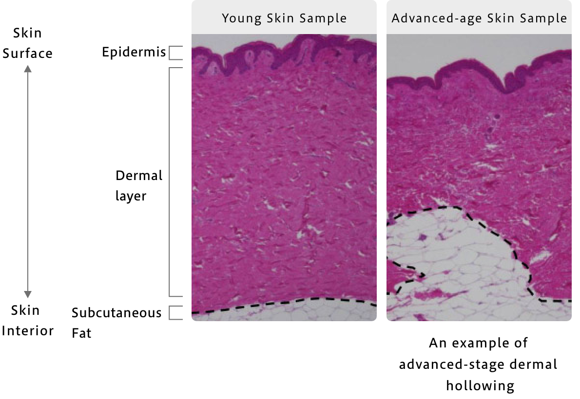 Discovery 2: Reduced Skin Firmness Through Dermal Cavitation