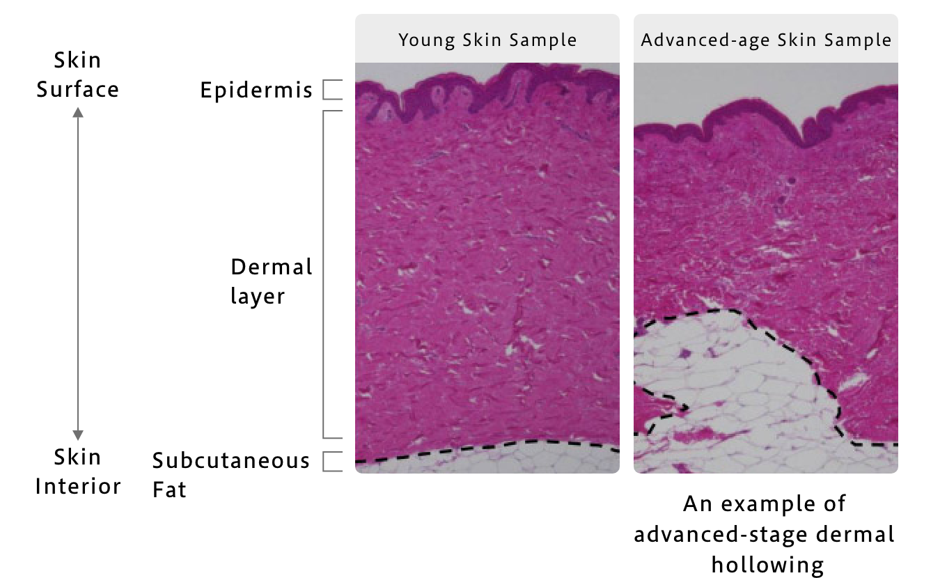 Discovery 2: Reduced Skin Firmness Through Dermal Cavitation