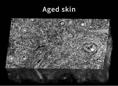 The structure of Ring Collagen deteriorates with age.