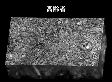 皮膚の中で収縮する力を生み出すリング状のコラーゲン構造 高齢者