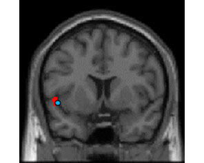 fMRI画像　水色部分：使い始めたばかりの化粧品に対する脳活動例