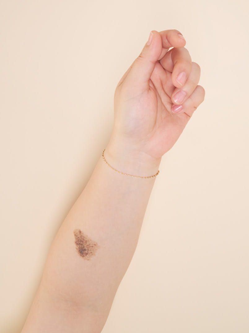Bare skin (birthmark on arm)