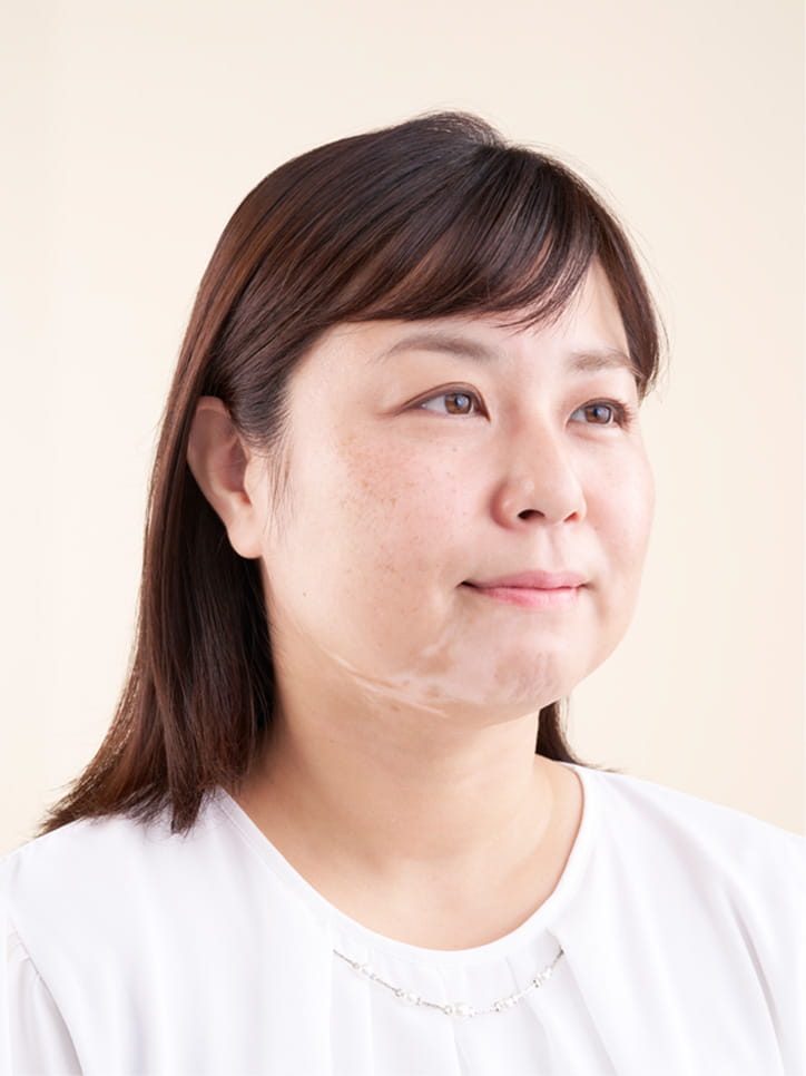素顔（白斑）